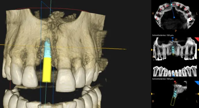 نرم‌افزار برنامه‌ریزی ایمپلنت با تصویر سه‌بعدی CBCT فک بالا و برش‌های مقطعی
