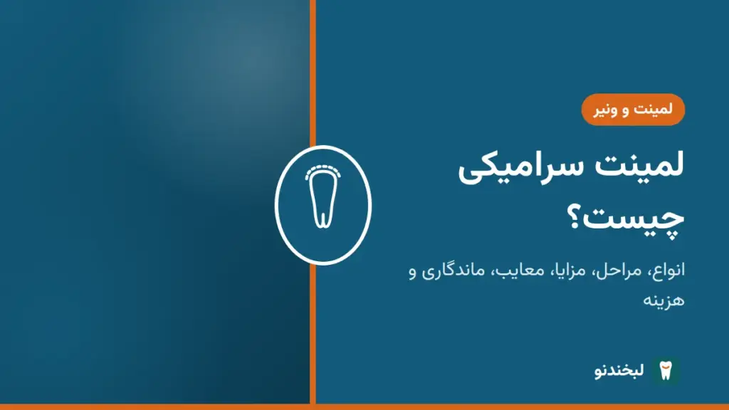 لمینت و ونیر: لمینت سرامیکی چیست؟ انواع، مراحل، مزایا، معایب، ماندگاری و هزینه