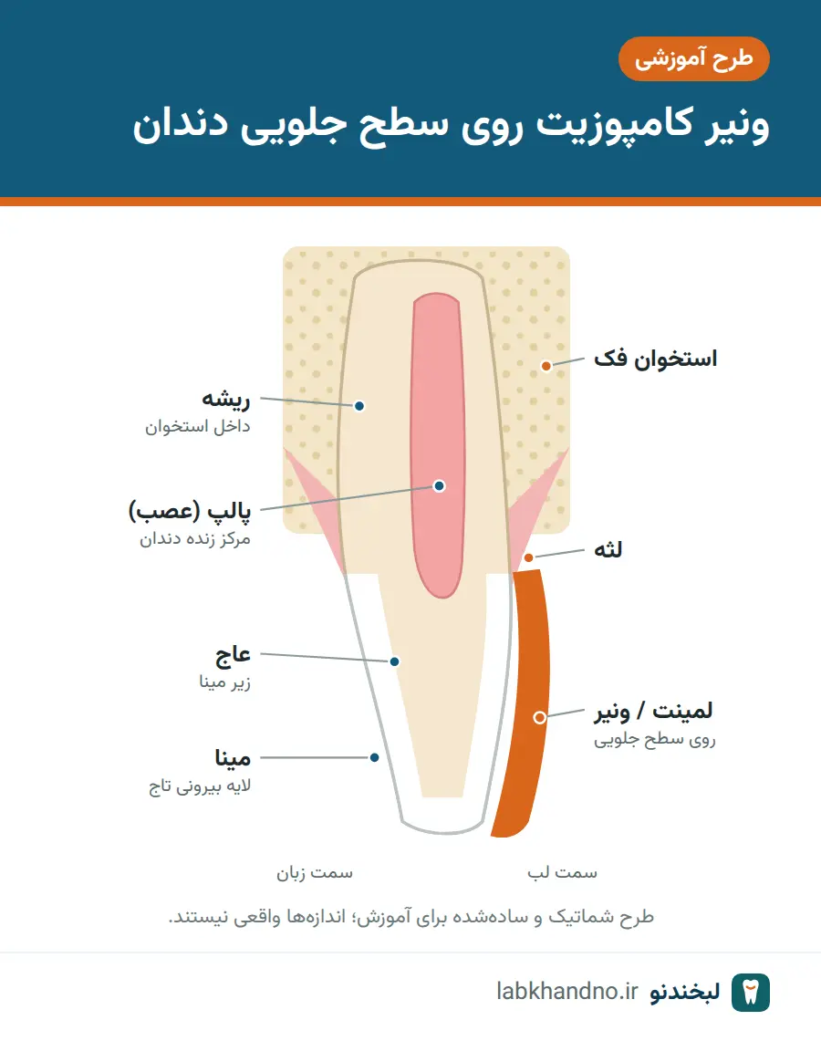 نمای شماتیک ونیر روی سطح جلویی دندان پیشین