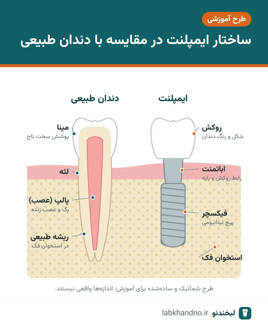 طرح شماتیک اجزای ایمپلنت در مقایسه با دندان طبیعی