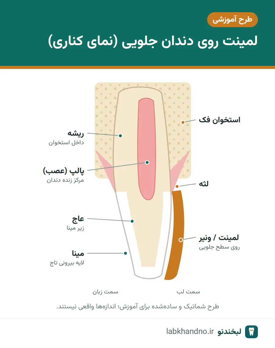 طرح شماتیک لمینت روی سطح جلویی دندان در لبخند هالیوودی