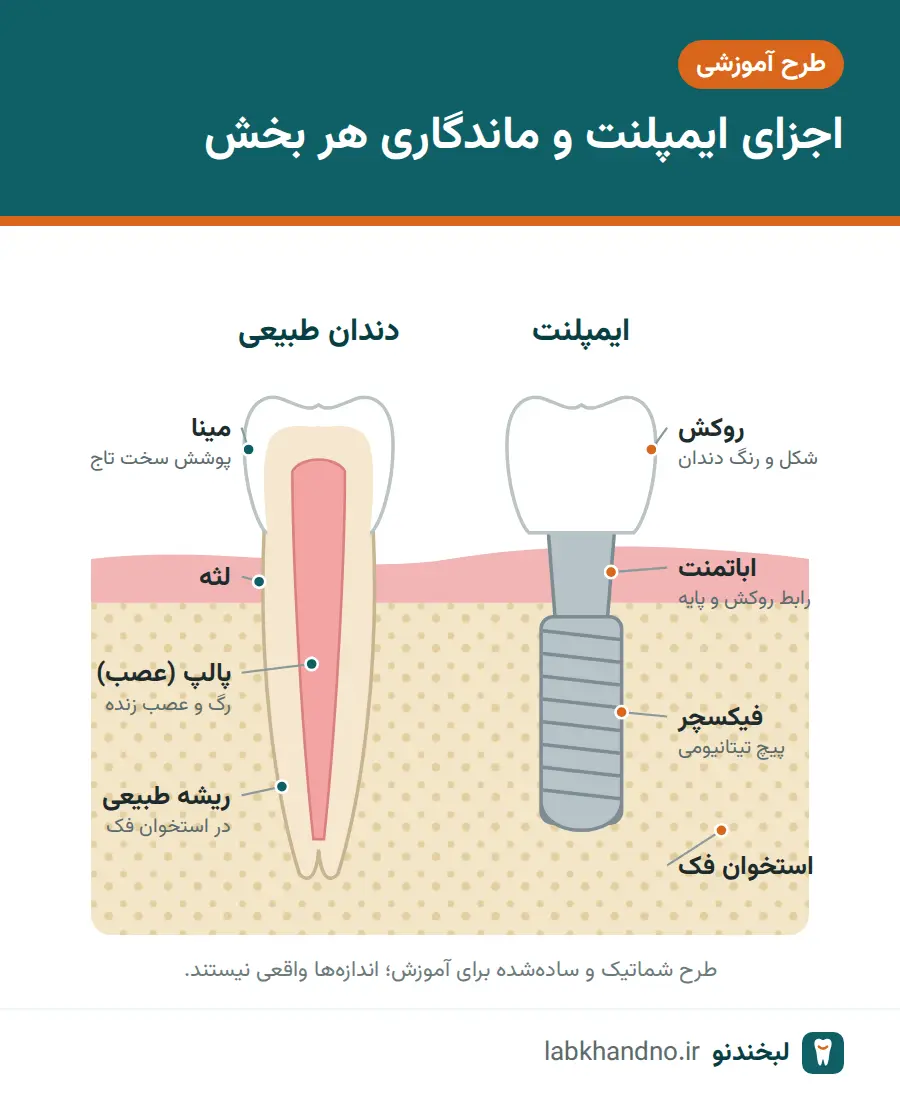 طرح شماتیک اجزای ایمپلنت دندان شامل فیکسچر، اباتمنت و روکش