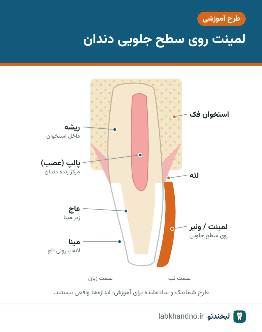 نمای شماتیک لمینت چسبانده‌شده روی سطح جلویی دندان پیشین