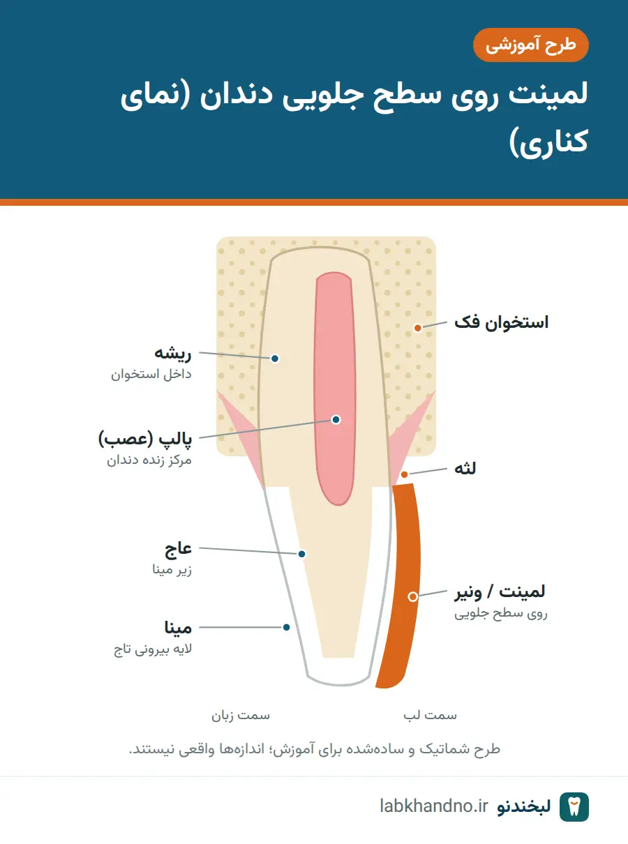 طرح شماتیک لمینت نازک روی سطح جلویی دندان