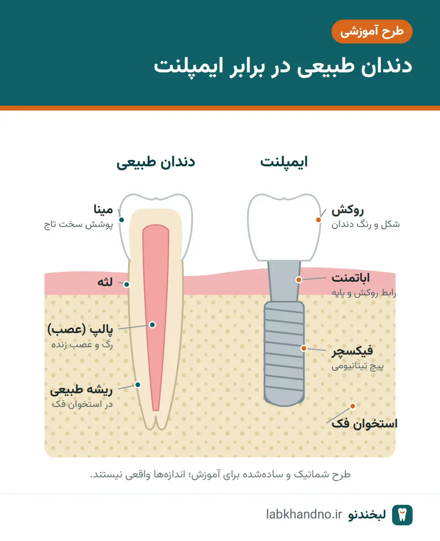 طرح شماتیک دندان طبیعی و ایمپلنت در کنار هم برای مقایسه عصب کشی یا ایمپلنت