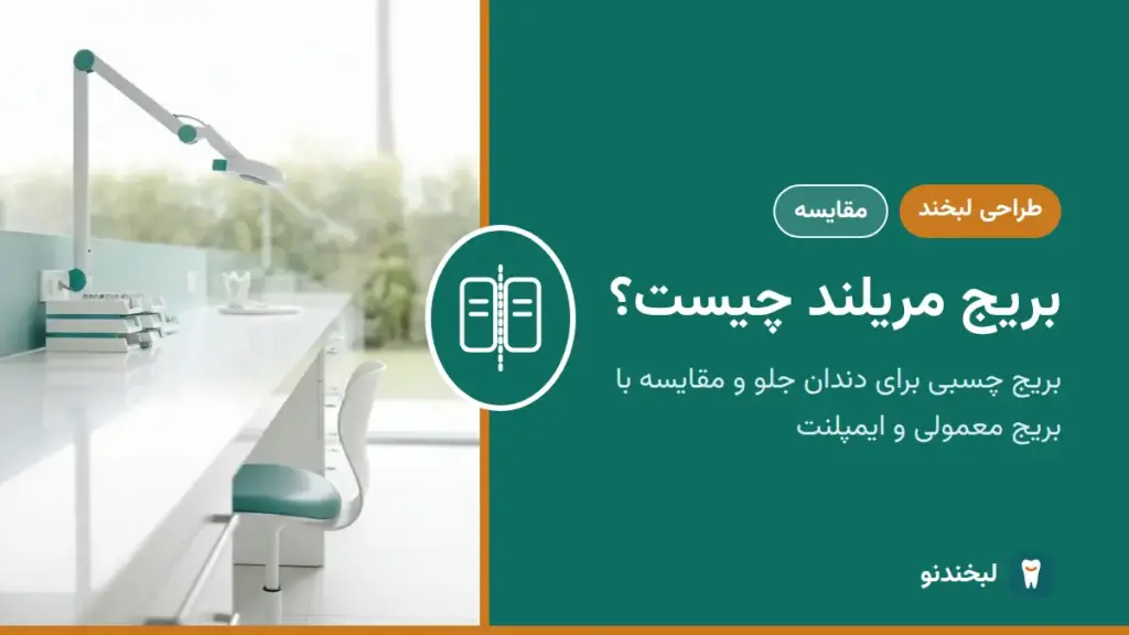 طراحی لبخند: بریج مریلند چیست؟ بریج چسبی برای دندان جلو و مقایسه با بریج معمولی و ایمپلنت