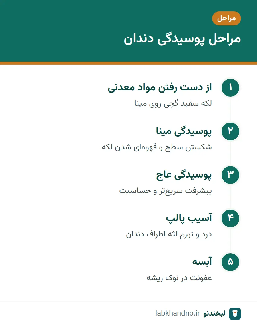 پنج مرحله پوسیدگی دندان از لکه سفید تا آبسه در نوک ریشه