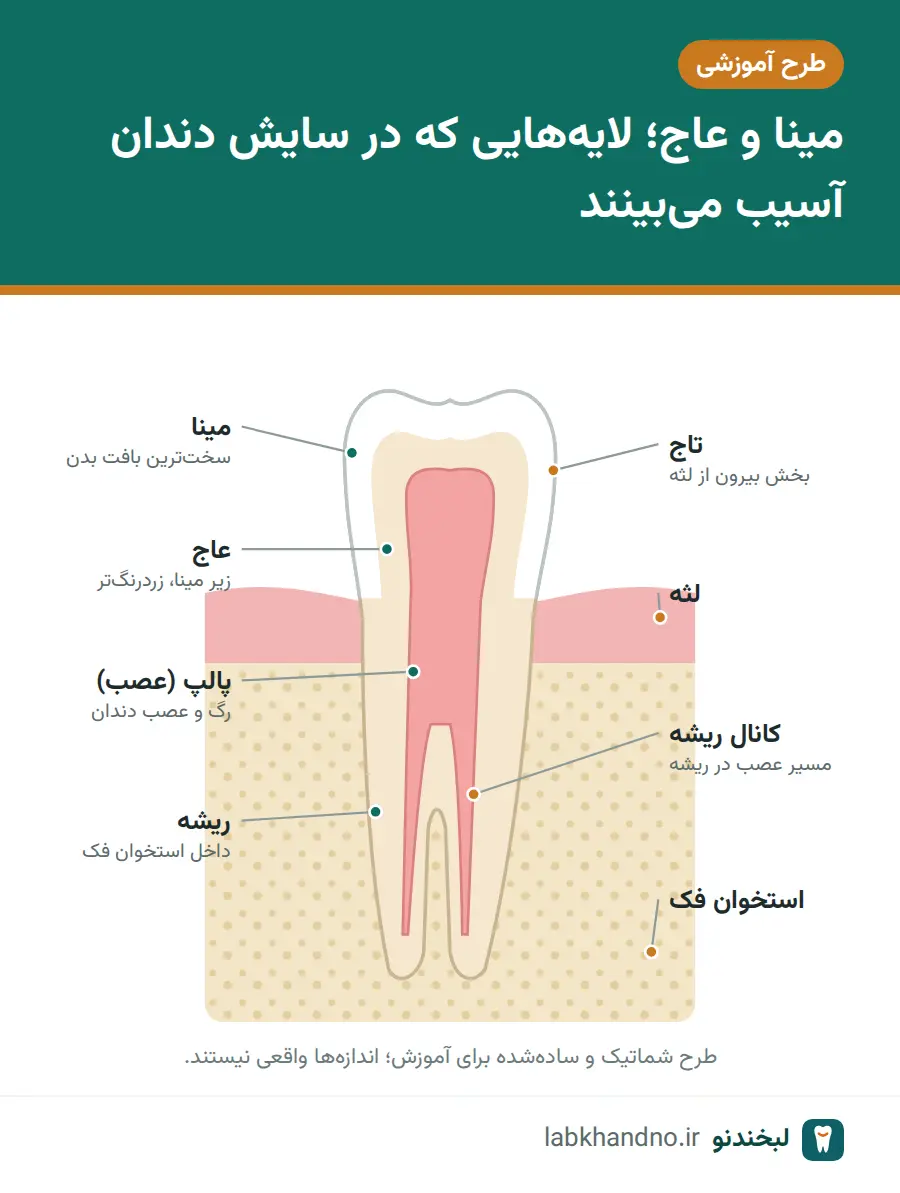 ساختار دندان؛ مینا، عاج و پالپ و جایگاه آنها در سایش دندان